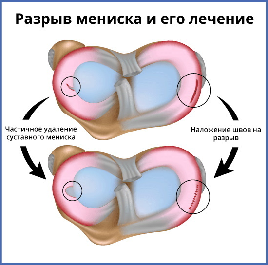 Rupture du ménisque du genou. Symptômes et traitement
