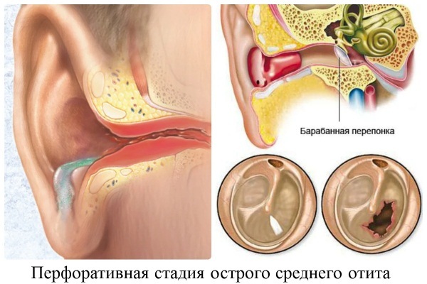 Treatment of otitis media in adults with folk remedies, drops, antibiotics. Symptoms of chronic, acute, suppurative, exudative, fungal
