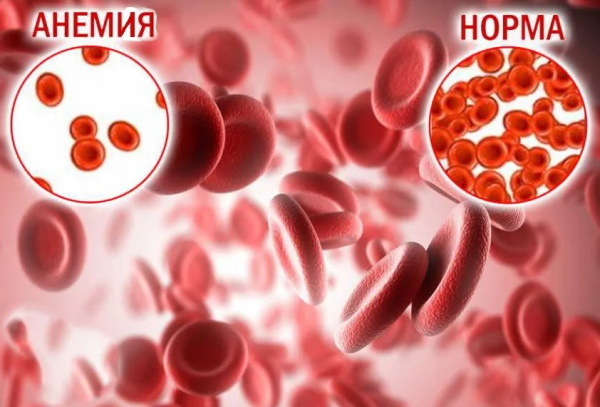 Anemia in women. Symptoms, causes, treatment