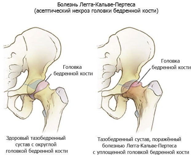 Diseases of the hip joint in women. Symptoms, first signs, treatment, causes