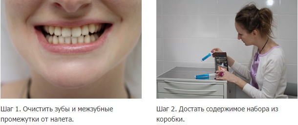 Namų dantų balinimas su burnos apsaugomis. Atsiliepimai, kaina