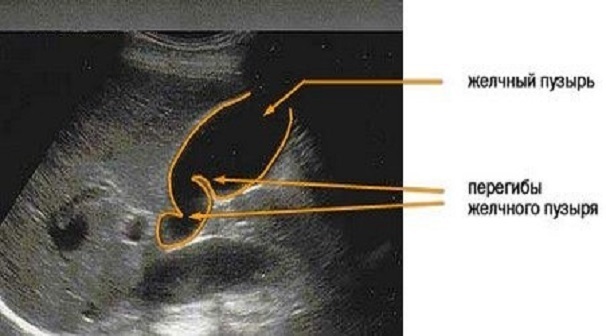 Deformasjon av galleblæren hos en voksen. Hva er det, årsaker, symptomer, behandling