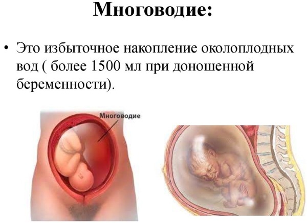 Apresentação pélvica do feto em 20-30-34 semanas de gestação. Entrega