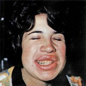 Melkersson-Rosenthalův syndrom: onemocnění tváře a charakteru