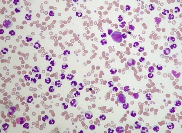 Blood leukocytosis. What is it in adults, children, pregnant women, causes, treatment, consequences