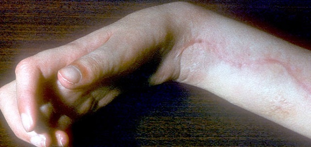 Congenital pathology of the fingers of the camptodactyly brush