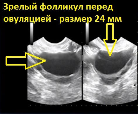 Dominant follicle. What is it, what size should it be by days of the cycle, ultrasound