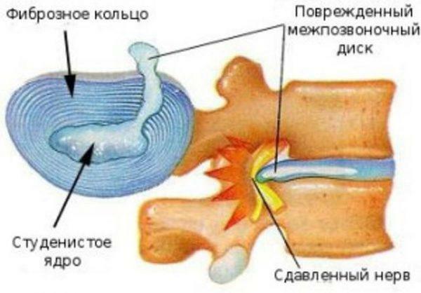 Osteocondrose da coluna torácica