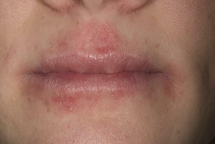 Dermatite atópica ao redor dos lábios