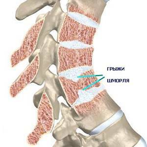 Herniated skorbut vertebral