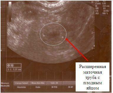 Кровить 6 недель беременности. Маточная беременность на УЗИ на раннем сроке. Внематочная Трубная беременность УЗИ. УЗИ на 4 неделе внематочная бер. УЗИ матки на первых неделях беременности.