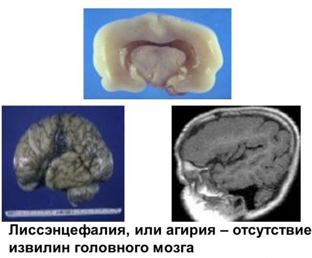 Felaktigheter i hjärnan: polymicrogyria, agiria och pahigiria