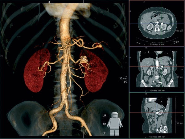 CT of the kidneys with contrast. What is it, what shows, preparation, contraindications, price