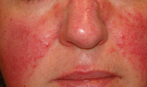 Rosacea: foto, cause, sintomi e trattamento della rosacea sul viso