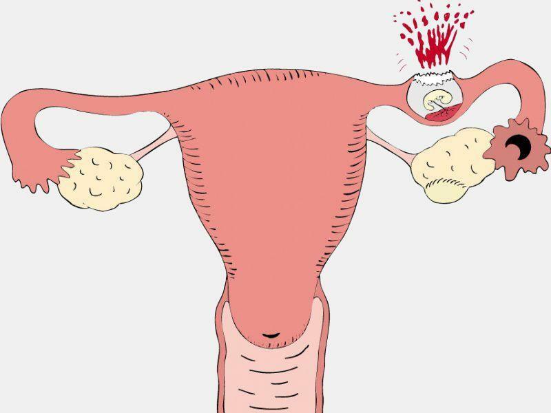 Az ectopiás terhesség első jelei a korai szakaszban - részletes információ