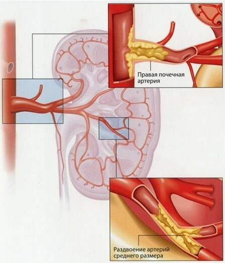 Arteriosklerose. Symptome und Anzeichen, was ist diese Krankheit?