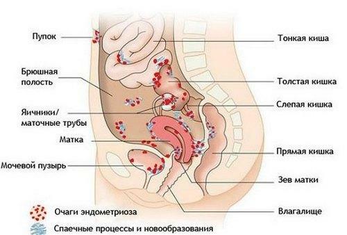 Endometriosis of the intestine: symptoms and treatment