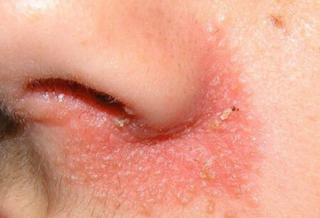 Seborrheic dermatitt på ansiktet