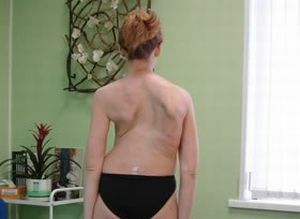 deformácia chrbtice