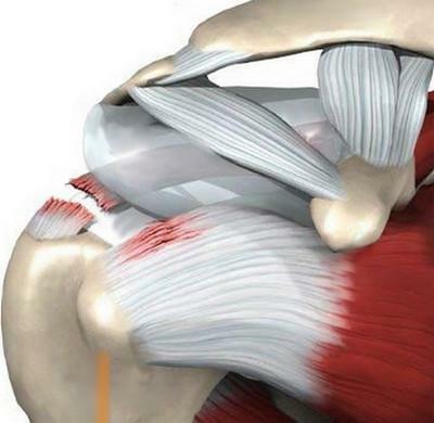 Ruptura de ligamentos de la articulación del hombro