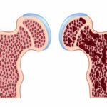 Osteoporose i hofteforbindelsen