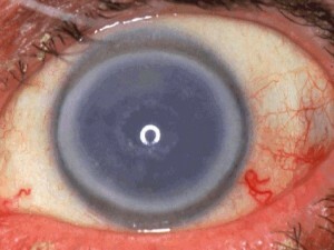 retinal dystrofi