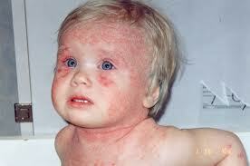 Allergi til huden hos børn: behandling, symptomer, foto
