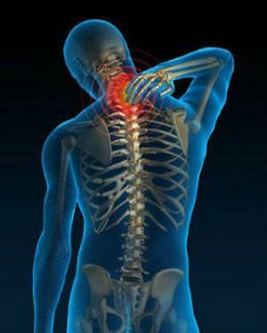 Cervico-Schulter-Syndrom, als Folge der Osteochondrose