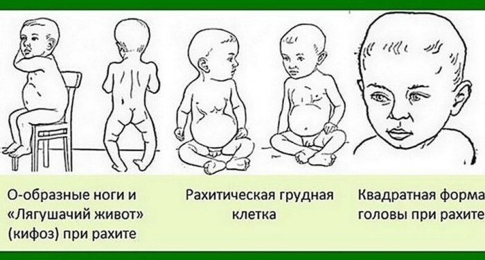 Žabji trbuh u djeteta, novorođenče. Vježbe kako očistiti