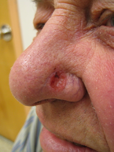 Basalioma på nesen. Foto, behandling, cytologisk bilde