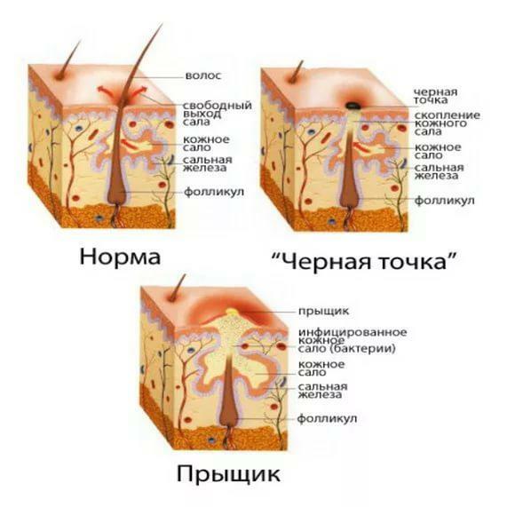 Structure of a pimple