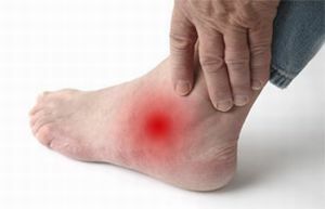 noga artritisa