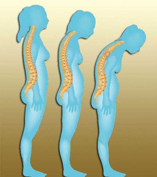 En el caso de osteoporosis, el cuerpo de las vértebras torácicas no puede soportar la carga