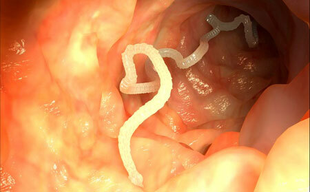 After the opening, a 6-meter tapeworm in a man was found