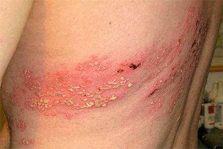 Shingles and its treatment