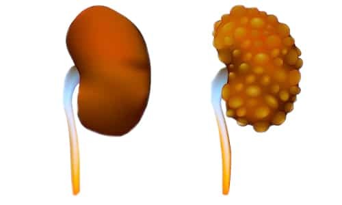 Rare renal anomalies: how to treat multicystic dysplasia