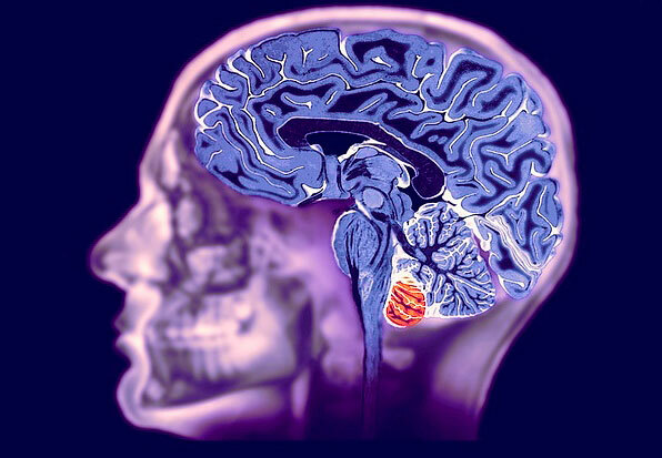Indikace pro MRI mozku