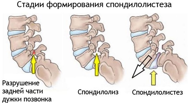 Retak di leher saat memutar kepala ke samping di pangkal tengkorak di belakang, sakit kepala. Alasan, perawatan di rumah