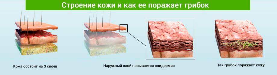 Procesul de leziune a pielii de ciuperci