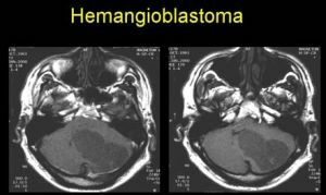 hemangioblastoma