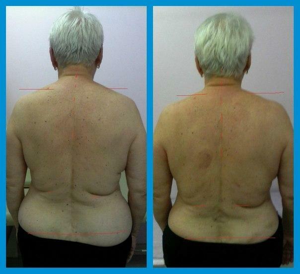 Üldine deformeeriv spondüloos enne ja pärast ravi, foto