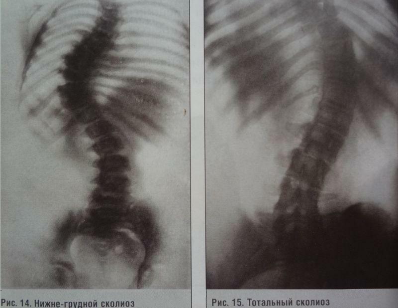 Foto rentgenové fotografie skoliózy zad
