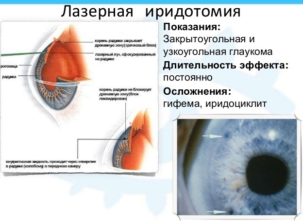 Laser iridectomy. What is it, indications, postoperative period, restrictions, price