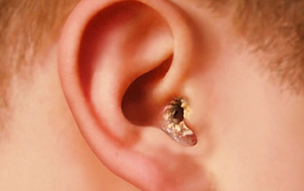 White plaque in the ears of the child, behind the ear, inside. What to do