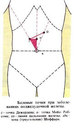 Tegn på betennelse i bukspyttkjertelen hos en kvinne