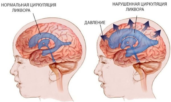 External cerebral replacement hydrocephalus in adults. What is it, prognosis treatment