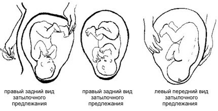 Cephalic presentation of the fetus at 20-30 weeks of gestation