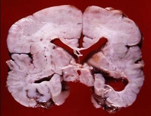 pahigiriya incisie van de hersenen