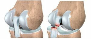 rupture of knee ligaments