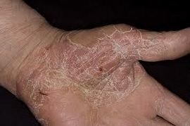 Eczema on the hands: treatment, photo, reasons, folk remedies